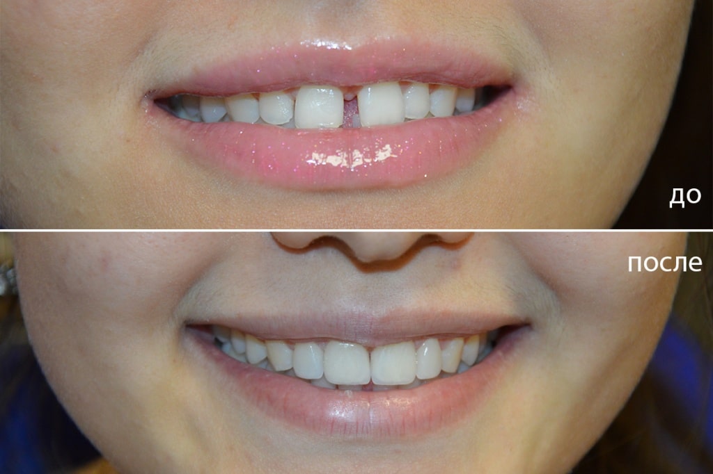 Ортодонтия зубов. Исправление прикуса и диастемы