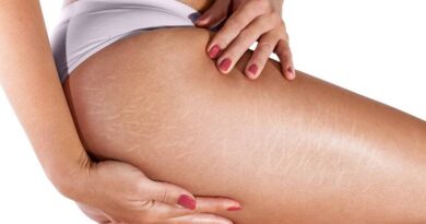 Как убрать растяжки после родов: полезные рекомендации