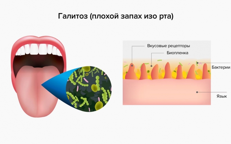 Неприятный запах изо рта (галитоз) – причины, заболевания, лечение
