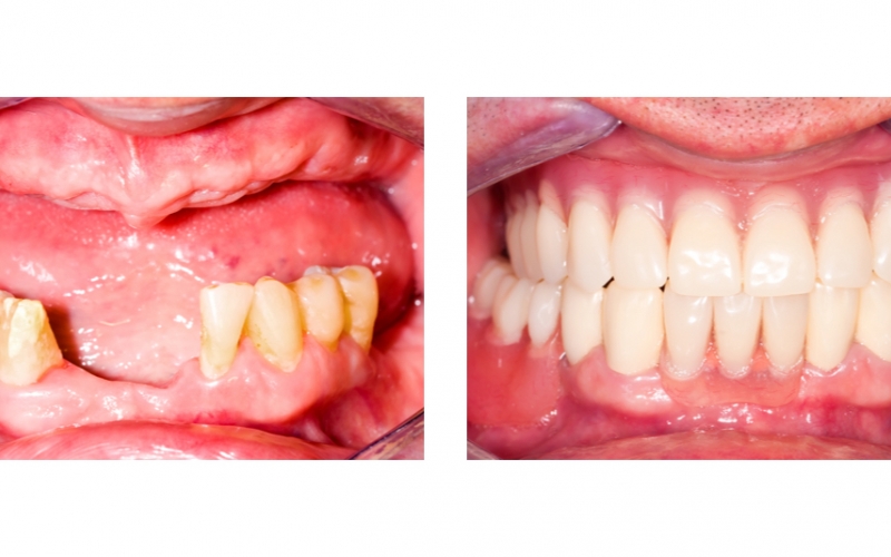 Протезирование зубов – виды зубных протезов, отзывы, фото до и после