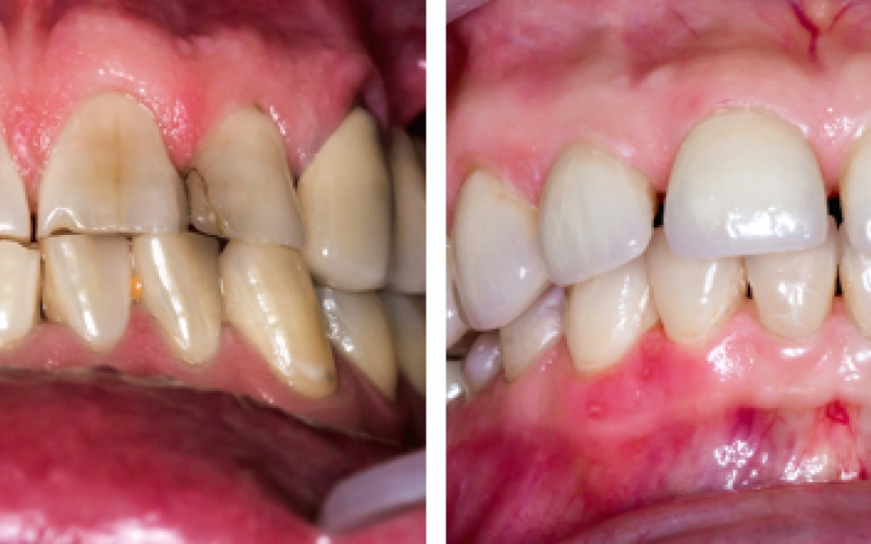 Реставрация зубов – фото до и после, методы, отзывы о художественной реставрации зубов
