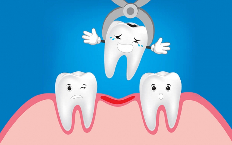 Удаление зубов у детей — показания, этапы, последствия — Startsmile