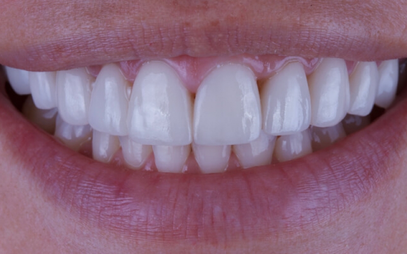 Виниры на передние зубы: что это, срок службы, виды, отзывы о виниринге