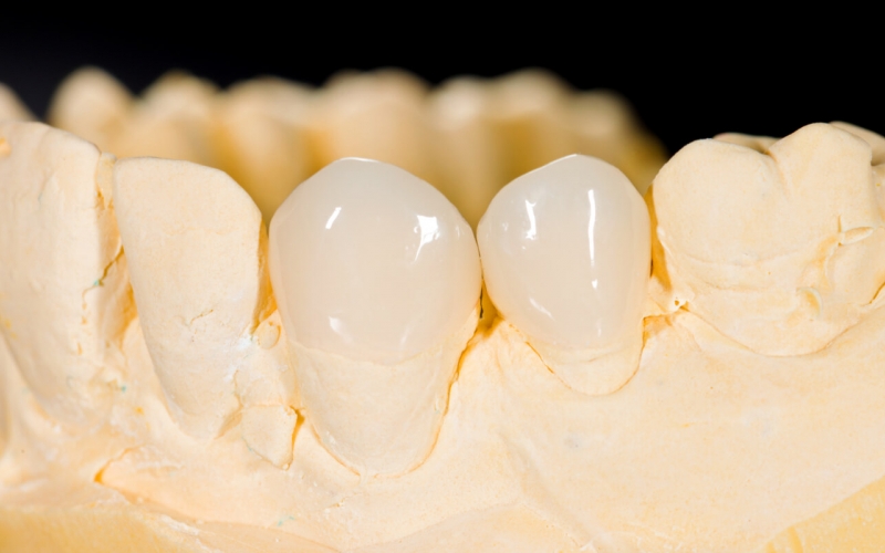 Зубные вкладки в стоматологии — плюсы и минусы, установка, показания — Startsmile