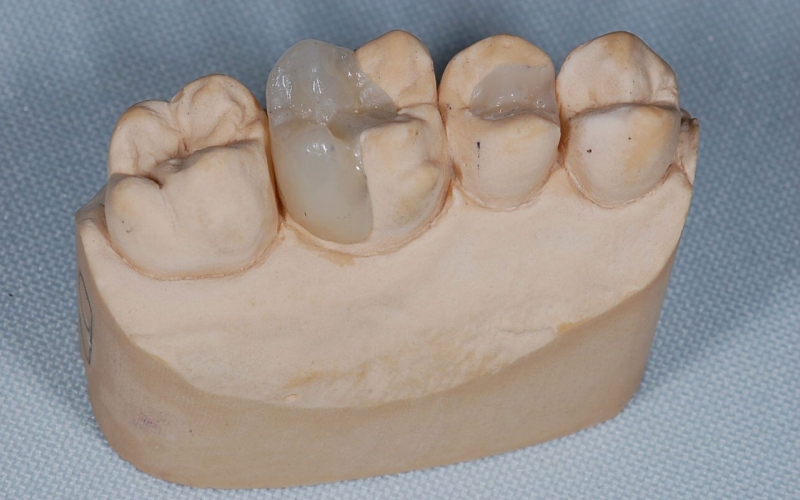 Зубные вкладки в стоматологии — плюсы и минусы, установка, показания — Startsmile