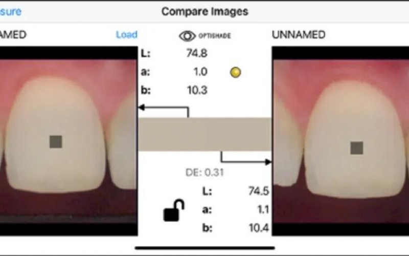 Цифровое определение оттенков зубов: практическое применение современного колориметра