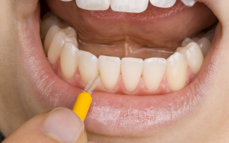 Исследование показало, что межзубные ершики и резиновые зубочистки являются наиболее эффективными устройствами