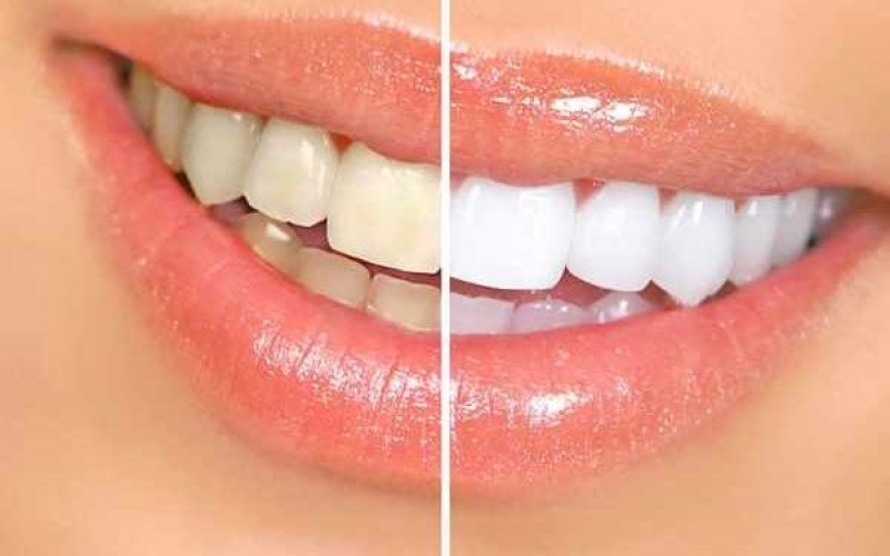 Использование наночастиц может стать лучшим способом отбеливания зубов