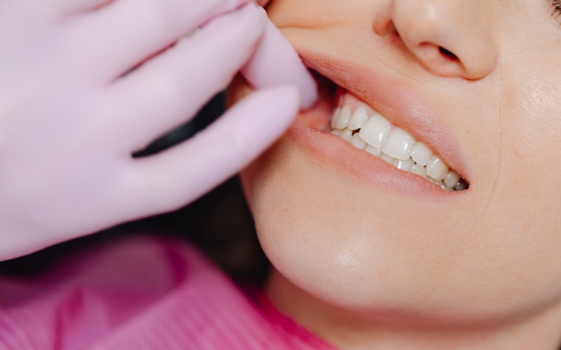 Зубной протез «бабочка»: как временно прикрыть отсутствие зуба