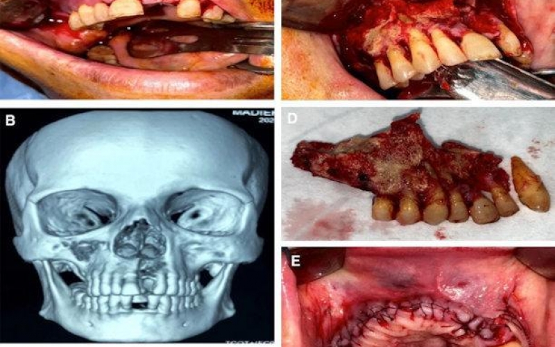Переболевшие COVID-19 подвергаются риску остеонекроза челюсти