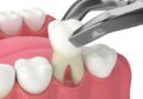 Преднизолон может вызвать задержку заживления после удаления зуба