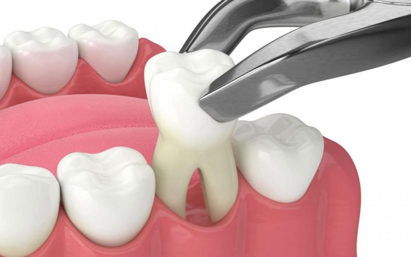 Преднизолон может вызвать задержку заживления после удаления зуба