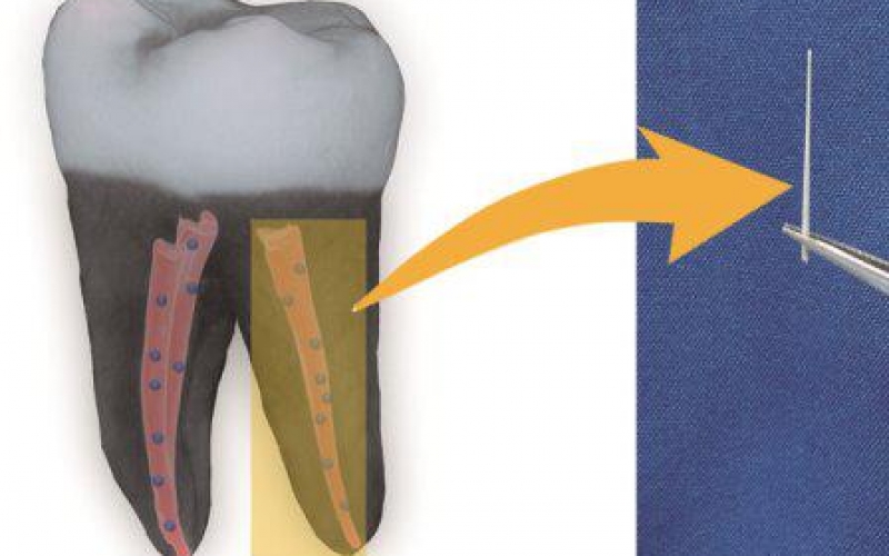 Найден способ сохранять зубы после лечения корневых каналов с помощью ультрадисперсных алмазов