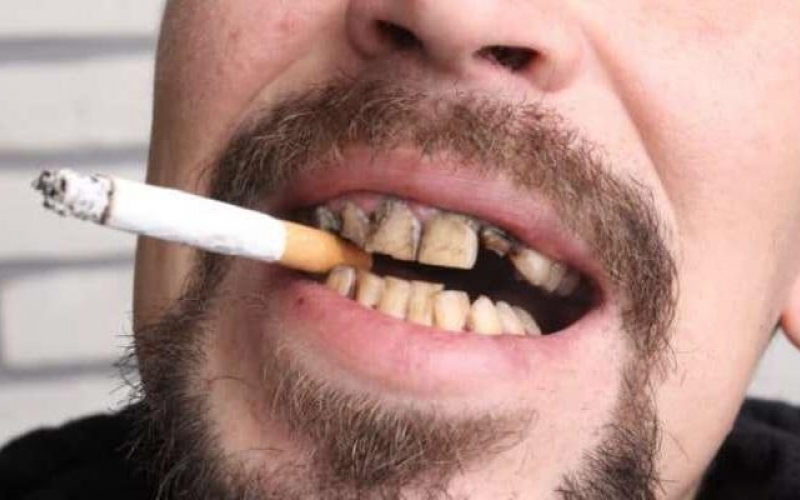 Влияние курения на лечение пародонтита