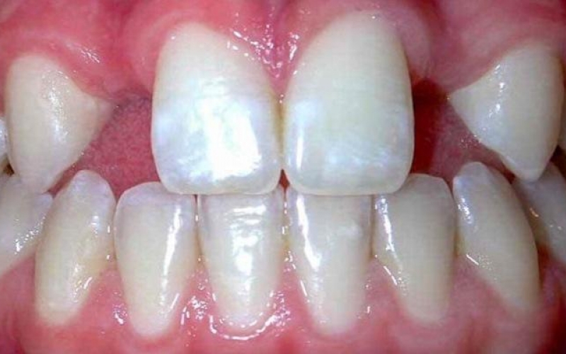 Исследователи изучают связь между агенезией зубов и атопическим дерматитом