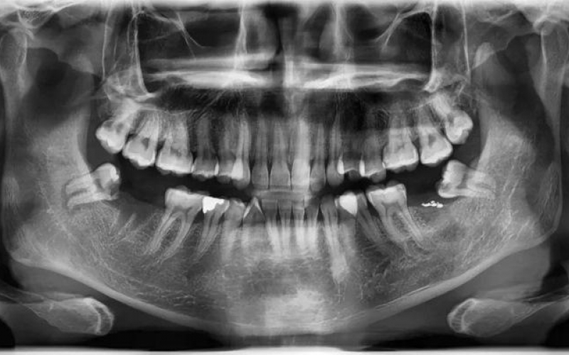 Всемирно известный метод оценки возраста по формированию третьих коренных зубов научно не подтвержден