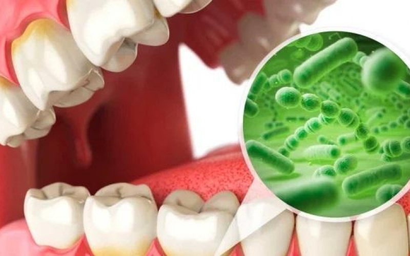 Исследование выявило новые виды бактерий, участвующие в образовании кариеса зубов