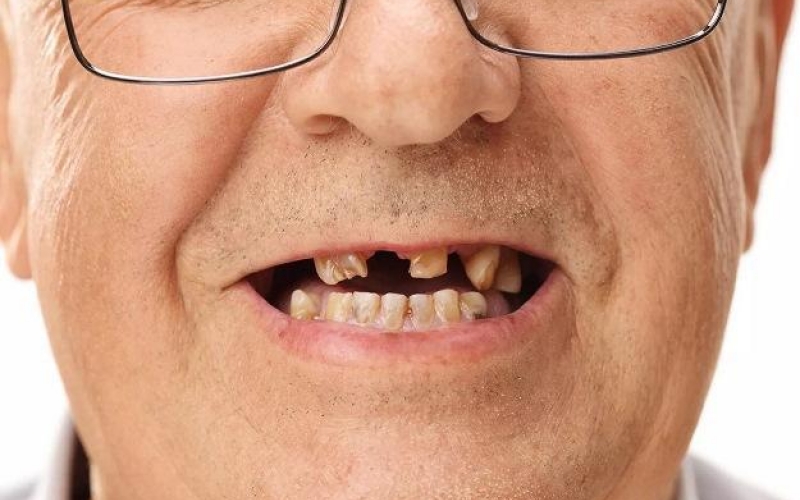 Потеря зубов увеличивает риск смерти у пожилых людей