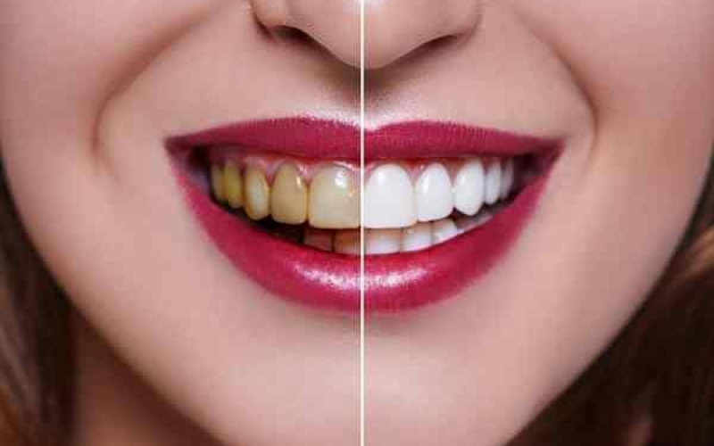 Является ли холодная плазма ключевым фактором лучшего отбеливания зубов?