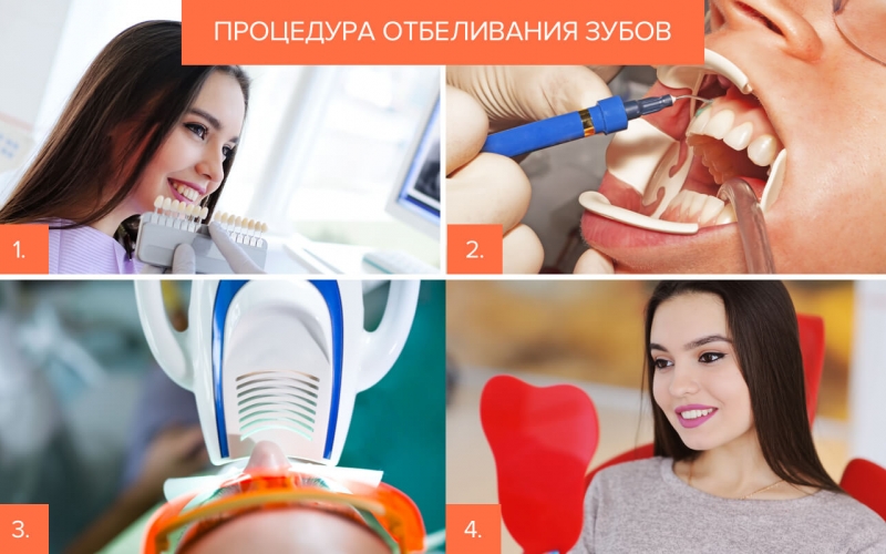 Отбеливание зубов – виды, способы, отзывы, фото