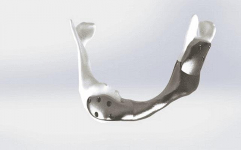 Первая титановая челюсть, напечатанная на 3D-принтере, установлена больному раком
