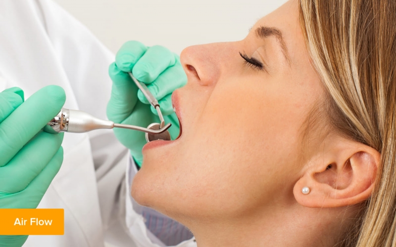 Зубной камень: как убрать с помощью чистки, причины и методы удаления зубного камня